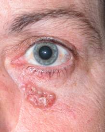 Eyelid Tumours 23