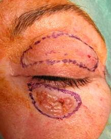 Eyelid Tumours 24