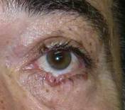 Eyelid Tumours 27