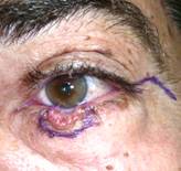 Eyelid Tumours 28